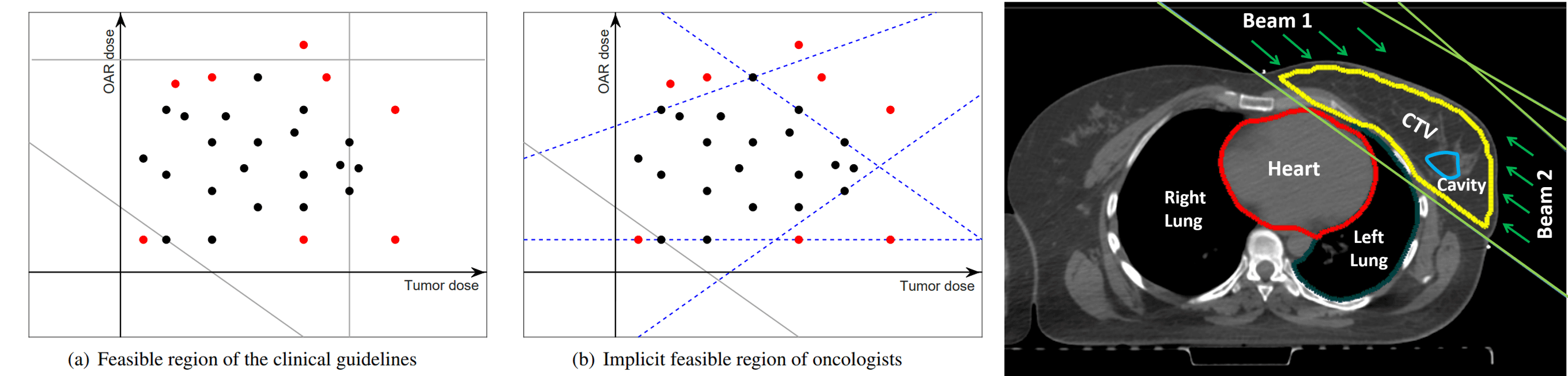Left:* A simplified example of a feasible region for clinical radiation therapy guidelines (gray solid) versus implicit (blue dashed) constraints in oncologists. The black and red dots denote accepted and rejected treatment plans, respectively. *Right:* A sample radiation therapy image for breast cancer.