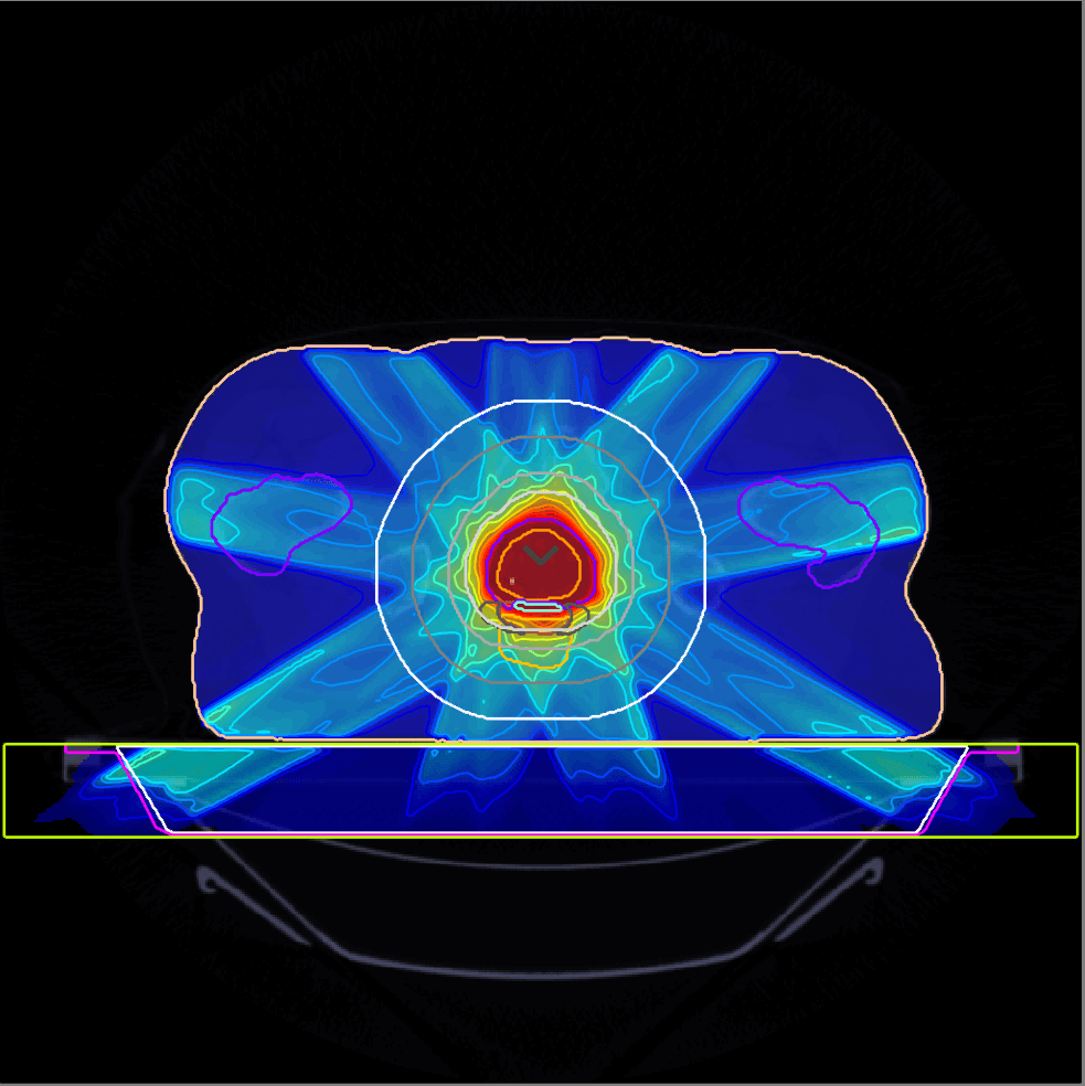 Radiation Therapy Treatment Planning via Inverse Optimization