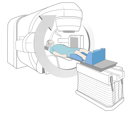 Schematics of radiation therapy treatment for cancer patients. The radiation delivery head rotates around the patient and focuses the radiation beamlets to a single focal point (an isocenter).